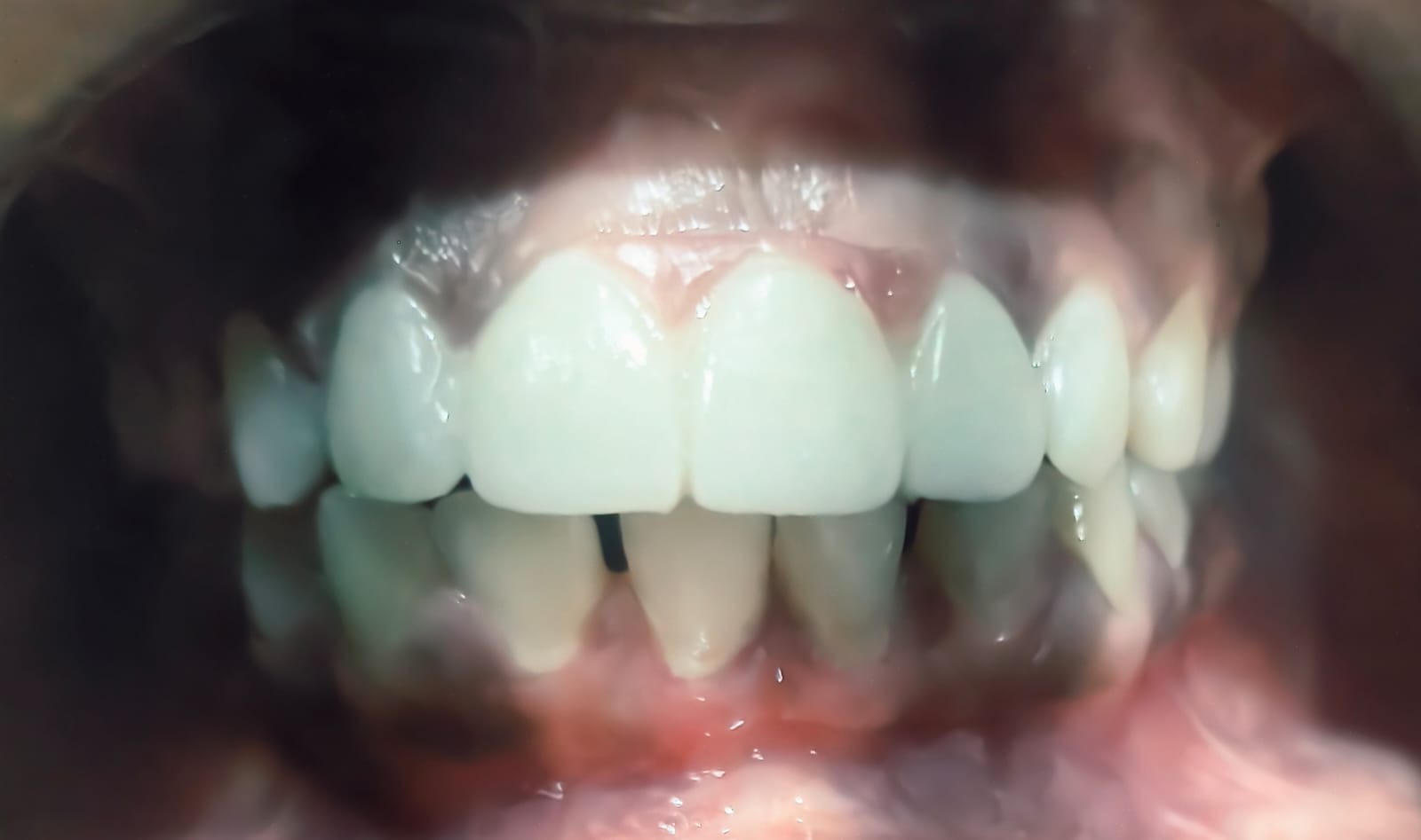 Smile Designing — After treatment at Dr Soujanya's clinic, Thiruverumbur