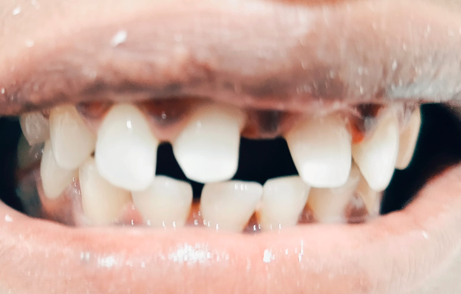 Smile Designing — Before treatment at Dr Soujanya's clinic, Thiruverumbur